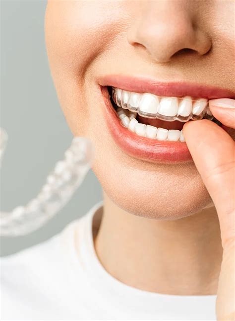 invisalign genève  Reddit gives you the best of the internet in one place